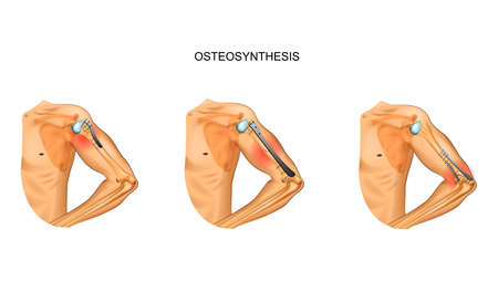 Core Physical Therapy Techniques for Chronic Back Pain