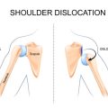 Nutrition and Lifestyle Choices that Speed Up Shoulder Recovery