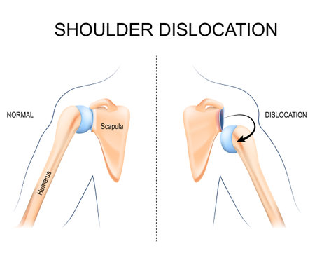 Nutrition and Lifestyle Choices that Speed Up Shoulder Recovery