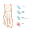 Common Challenges in Rotator Cuff Rehabilitation and How to Overcome Them