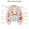 Adapting Rehabilitation for Elderly Patients After Tendon or Ligament Repair